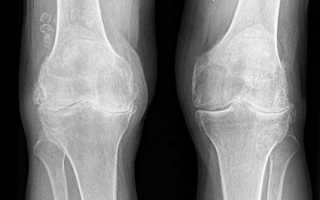 Остеоартроз коленного сустава 1, 2 степени