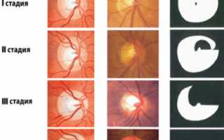Какие существуют стадии глаукомы и чем они отличаются?