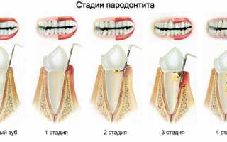 4 степени развития пародонтального кармана