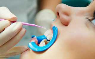 Проверенные методы реминерализации эмали зубов
