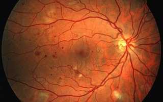 Можно ли при ретинопатии пить Ксарелто: показания к использованию