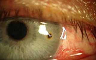 Ожог роговицы глаза: первая помощь и лечение