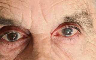 Как определить катаракту глаза в домашних условиях у взрослых?