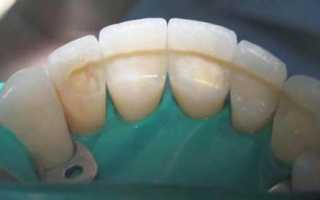 Использование риббонд ленты в стоматологии