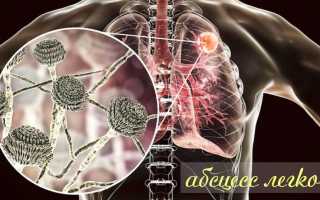 Абсцесс лёгкого: как лечить, причины, симптомы