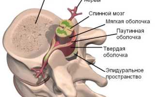 Лечение Перелома Позвоночника с Повреждением Спинного Мозга