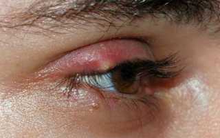 Как начинается ячмень на глазу: симптомы, причины, диагностика
