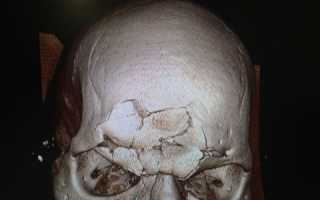Открытый перелом черепа: первая помощь и лечение