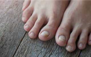 Дерматофитный микоз ногтей: внешний вид, причины, лечение