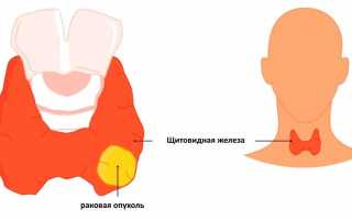 Рак щитовидной железы — симптомы и лечение