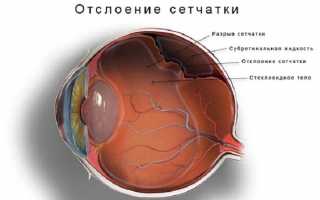 Чем опасно отслоение сетчатки глаза? Причины, симптомы и методы лечения