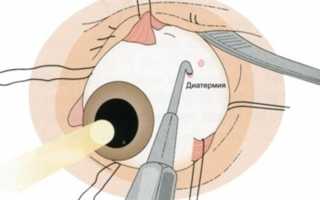 Отслоение сетчатки глаза с разрывом – причины развития и лечение
