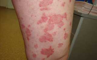 Грибовидный микоз кожи: симптомы и методы лечения