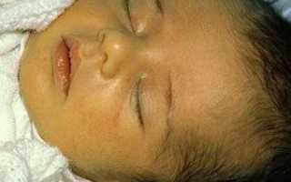Причины и последствия желтухи у новорожденных