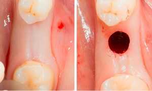 Современный метод безоперационной имплантации зубов