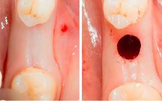 Современный метод безоперационной имплантации зубов