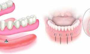 Полезные сведения о зубных протезах и рекомендации