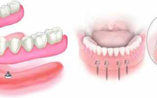 Полезные сведения о зубных протезах и рекомендации