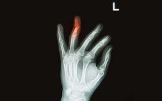 Перелом безымянного пальца: признаки и лечение