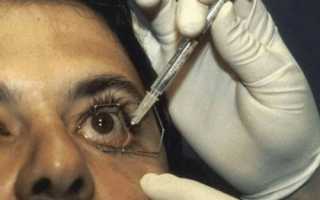 Нужно ли делать уколы в глаза при глаукоме?