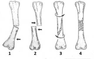 Закрытый перелом: особенности травмы и оказание первой помощи