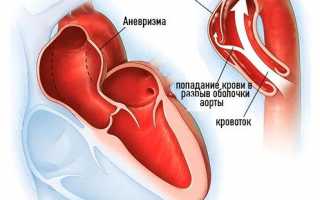 Расслаивающая аневризма грудной аорты