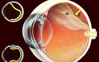 Что такое центральная хориоретинальная дистрофия сетчатки глаза и как она влияет на глаз?