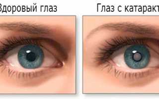 Как развивается катаракта?