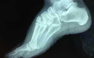 Перелом 5 плюсневой кости стопы: лечение и реабилитация