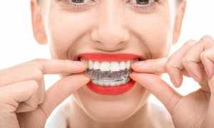 Причины искривления зубов после ношения брекетов