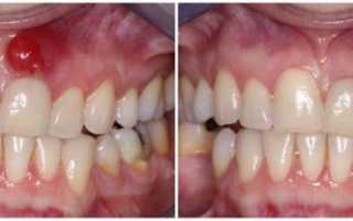 Классификация и симптоматика периостита челюсти