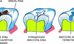 2 методики герметизации фиссур зубов у детей и взрослых