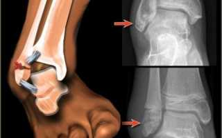 Реабилитация после перелома лодыжки с подвывихом и смещением