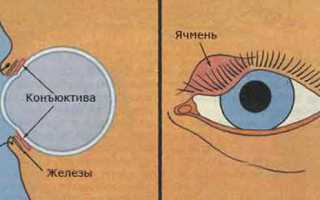 Как прорывается ячмень на глазу — средства, ускоряющие процесс