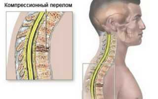 Компрессионный Перелом Позвонка Грудного Отдела: История Болезни